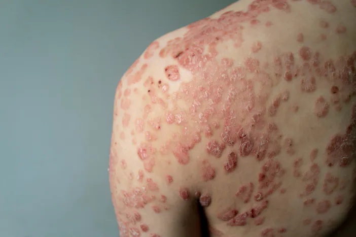 ภาพครอประยะใกล้ของบริเวณร่างกาย เห็นผิวนูนและเป็นขุยหลายตำแหน่งใกล้รอยพับของผิว