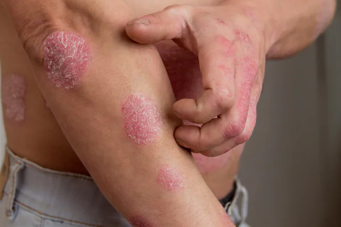 ภาพครอปลำตัว แขน ข้อศอก และมือ เห็นบริเวณผิวที่มีขุยหลายตำแหน่ง